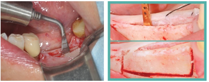 Ridge split / expansion Along with Implants, Dental implant in jaipur