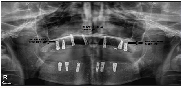 Sinus lift in upper posterior implants, Dental Implant in Jaipur