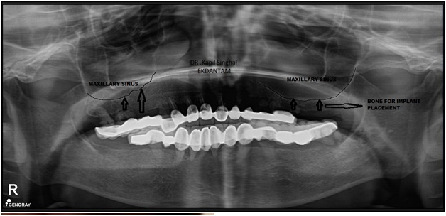 Sinus lift in upper posterior implants, Dental Implant in jaipur