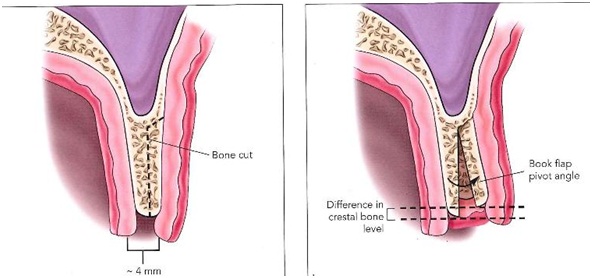 Ridge split / expansion Along with Implants, Dental implant in jaipur