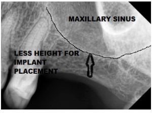 Sinus lift in upper posterior implants, Dental clinic in jaipur