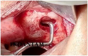 Sinus lift in upper posterior implants, Dental clinic in jaipur