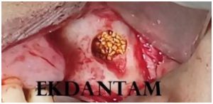 Sinus lift in upper posterior implants, Dental implant in Jaipur