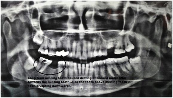 Single Tooth implant