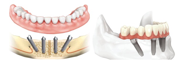 All on 4 full Mouth implant, Full dental implant in jaipur, best dental implants in india, 