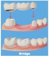 Bridge to replace a missing tooth, Dental implant in Jaipur, Bets Dentist in Jaipur, Dental clinic in jaipur