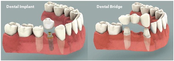 Implant V/s Bridge, Dental clinic in jaipur, Best Dentist in jaipur, Dental implant in jaipur