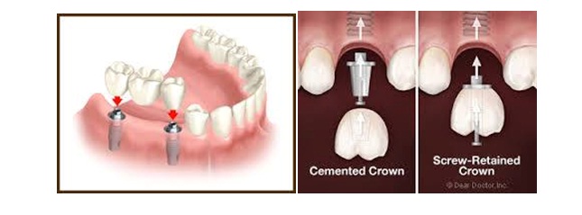 What is the procedure of Dental Implants, Best Dental Implant In Jaipur, Best Dentist in Jaipur