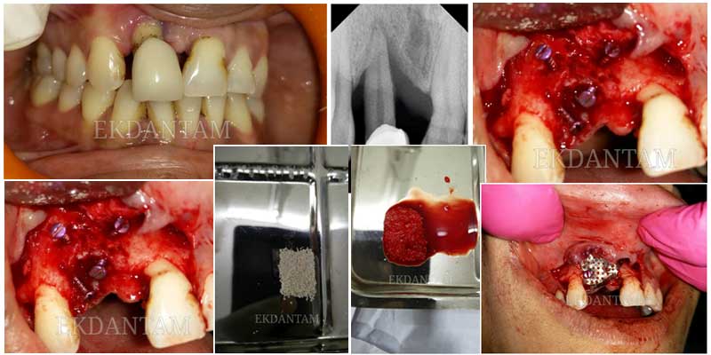 Bone loss due to Trauma or pyorrhea, full tooth or dental implant in jaipur
