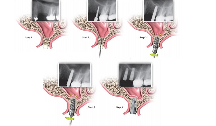 What is Osseodensification, Dental implant in jaipur, Dentist in jaipur, best Dental clinic in india
