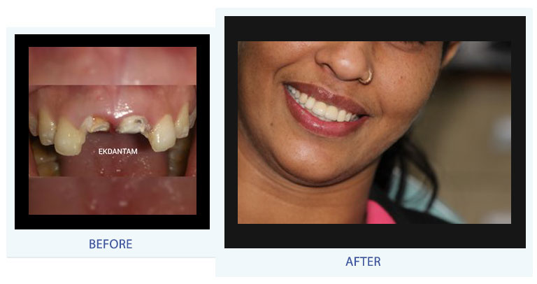Dental implants in jaipur, tooth implant in india