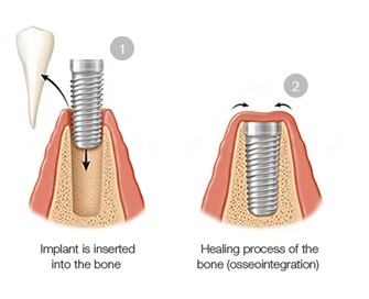 full dental implants in jaipur, dental implants in india, dental implants are not scary and painful