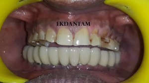 dental implant 