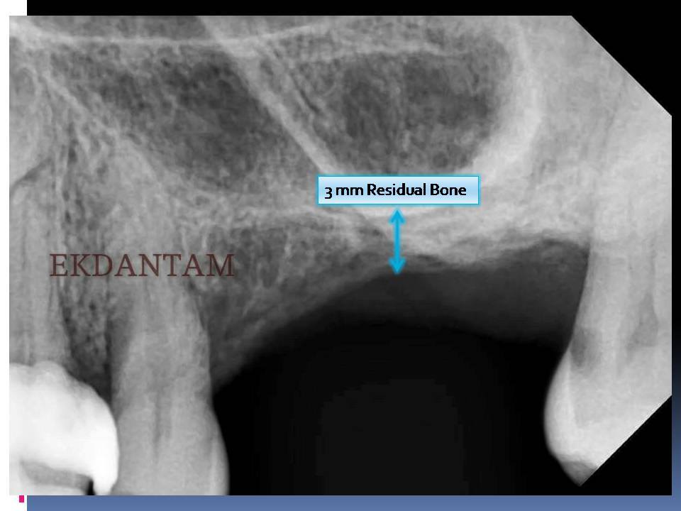 best dental implant clinic in jaipur 