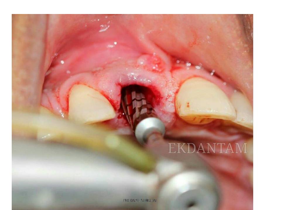 Best dental implant in jaipur 