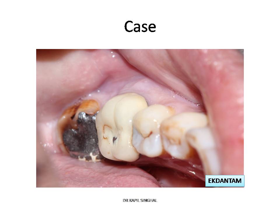 dentalimplant