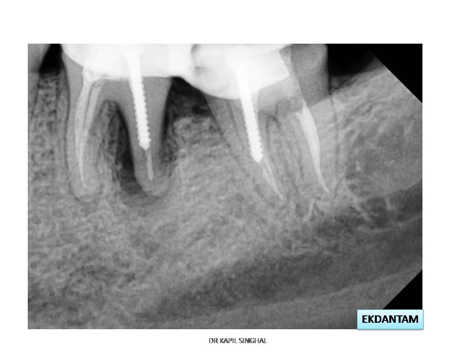 dentalimplant