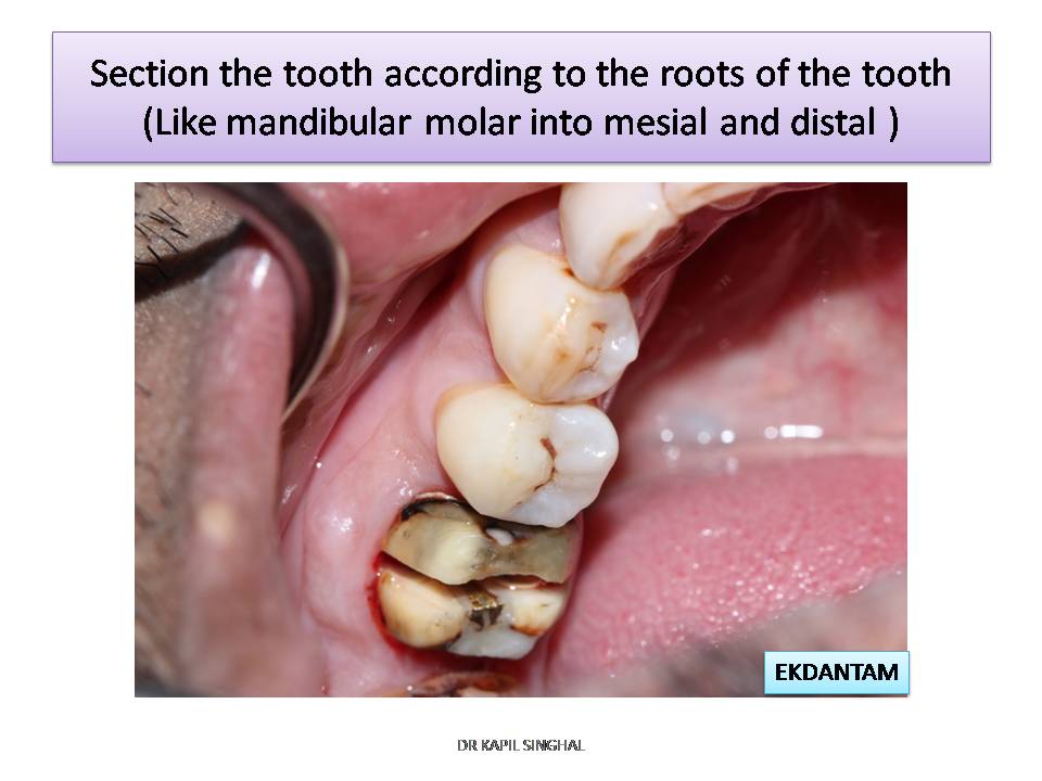 dentalimplant