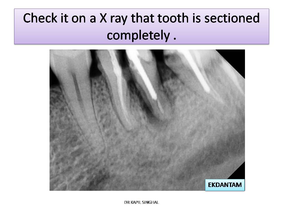 dentalimplant