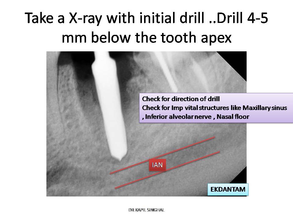 dentalimplant