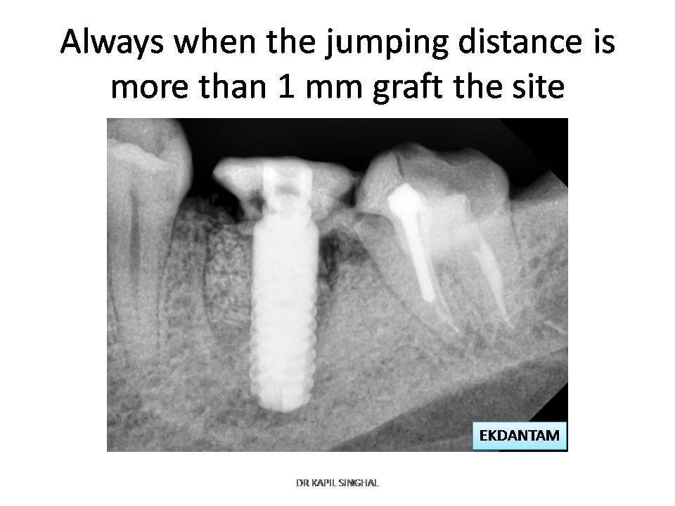 dentalimplant