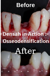 Immediate implant in lower right First Molar