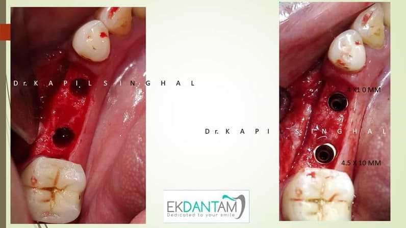 Delayed implant in lower right premolar and  Molar region
