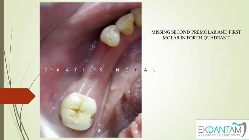 Delayed implant in lower right premolar and  Molar region