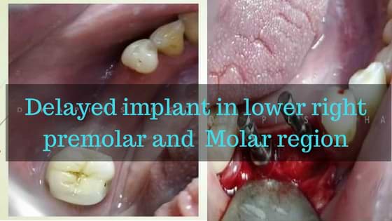 Delayed implant in lower right premolar and Molar region