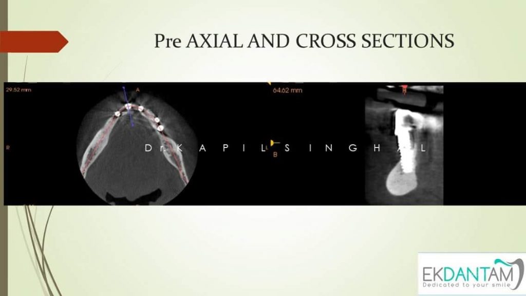 Pre AXIAL and Cross Section