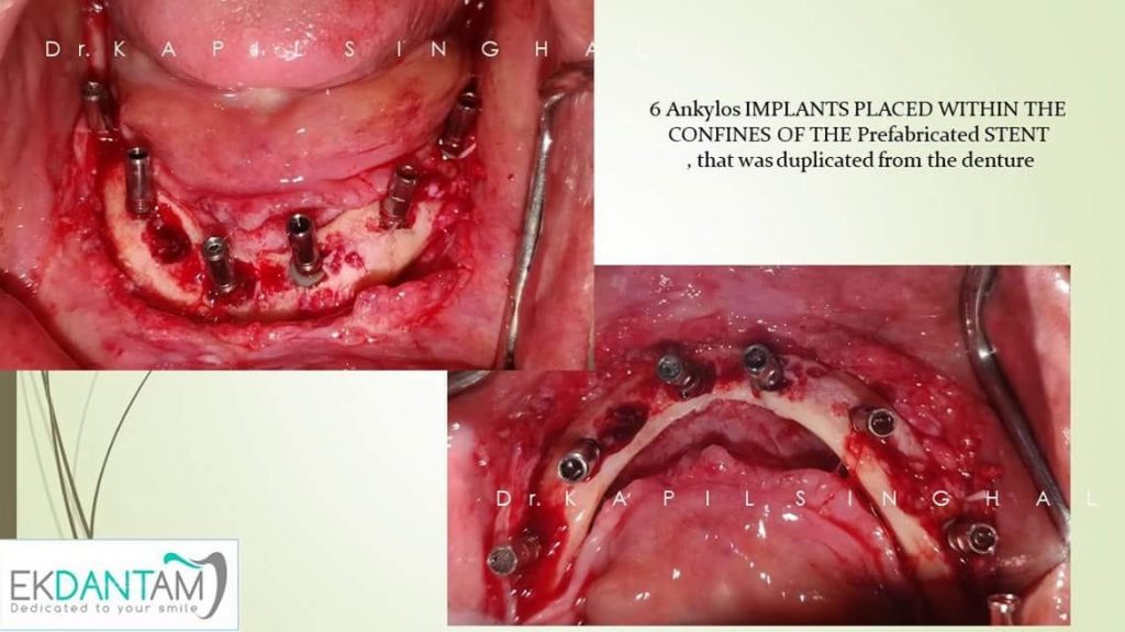 Ankylos Implants Placed within the confines of the prefabricated