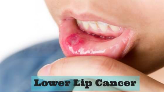 lower lip cancer