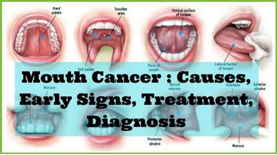 Mouth Cancer _ Causes, Early Signs, Treatment, DiagnosisAdd subheading (1)