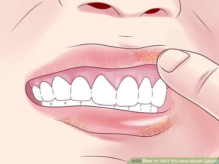 Mouth cancer -  bottom lip