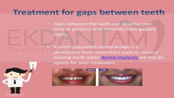 gap between teeth Treatment