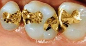 Gold Fillings