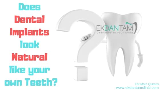 Does Dental Implants look Natural like your own Teeth
