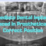 Immediate Dental Implants Placed in Prosthetically Correct Position