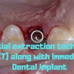 Partial extraction technique (PET) along with Immediate Dental implant