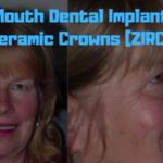 Full-Mouth-Dental-Implant-with-all-Ceramic-Crowns-ZIRCONIA-2-1