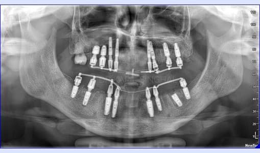 Full-Mouth-Dental-Implants