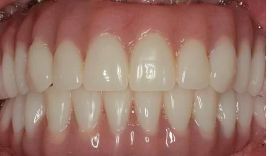 Full-mouth-dental-Implant-with-immediate-loading